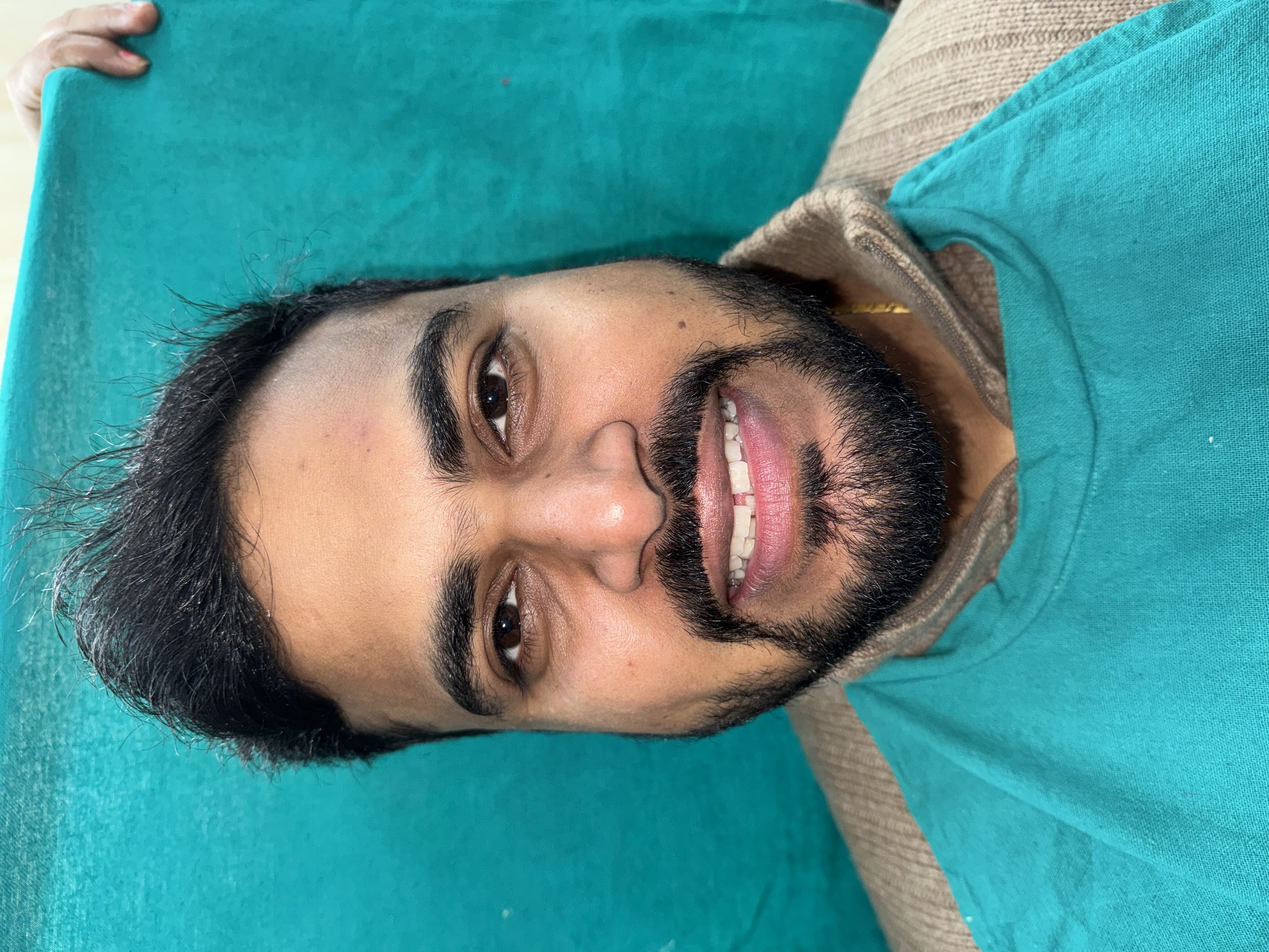 Pre-treatment image showing midline diastema spacing